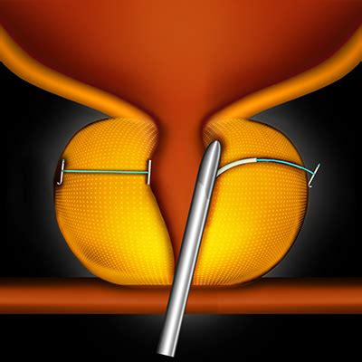 roulify|UroLift® System Procedure Animation .